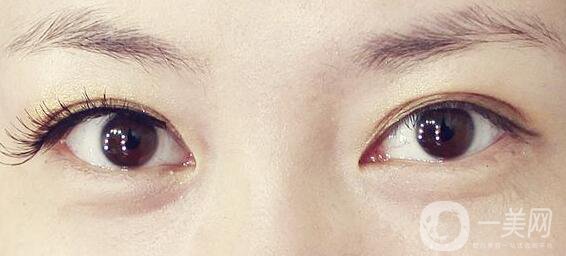 不開(kāi)刀的雙眼皮是*的嗎？