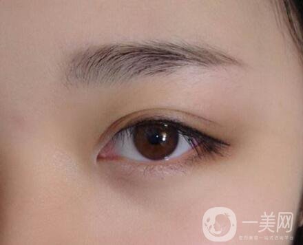 不開(kāi)刀的雙眼皮是*的嗎？