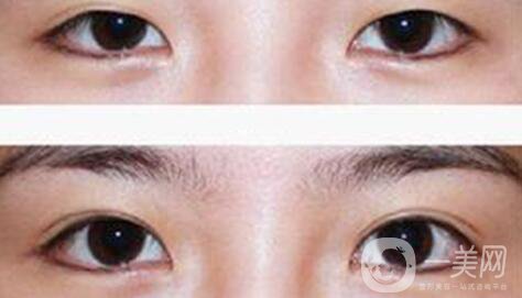 上海九院割雙眼皮多少錢 上海九院做雙眼皮價(jià)格詳解