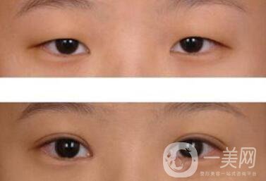 威海割雙眼皮多少錢？雙眼皮手術(shù)價格詳解