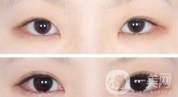 韓式*開眼角多少錢  韓式*開眼角恢復圖