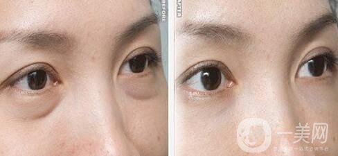 超聲法去眼袋怎么樣 超聲法祛眼袋多少錢
