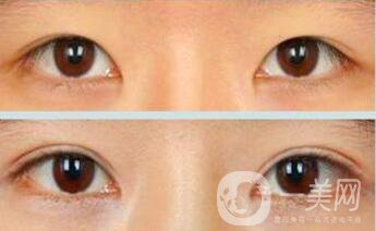 三點(diǎn)定位雙眼皮手術(shù)有副作用嗎、*果怎么樣