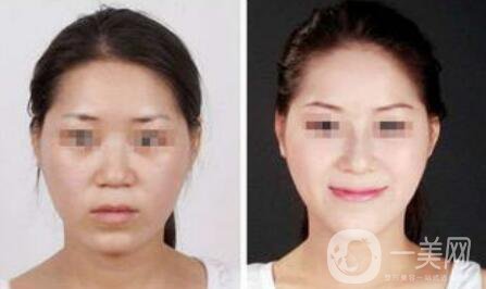 注射隆鼻一般多少錢？廣東隆鼻注射價格介紹