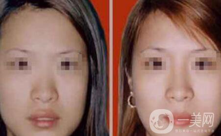 注射隆鼻一般多少錢？廣東隆鼻注射價格介紹