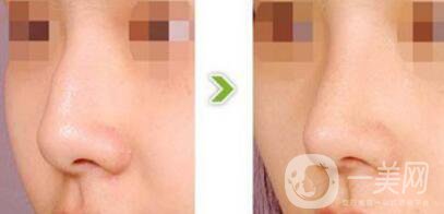 杭州駝峰鼻矯正多少錢 駝峰鼻手術(shù)價格