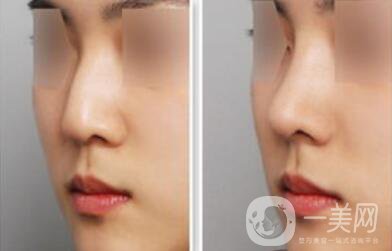 杭州駝峰鼻矯正多少錢 駝峰鼻手術(shù)價格