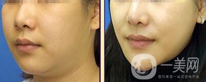 等離子激光溶脂價格、大概需要多少錢