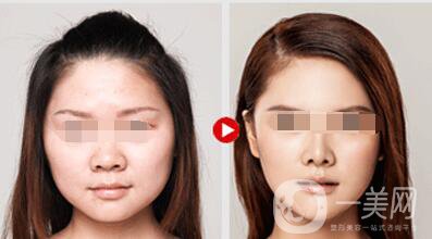 等離子激光溶脂價格、大概需要多少錢