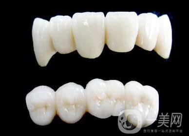 烤瓷牙能用多長(zhǎng)時(shí)間？烤瓷牙的壽命有多長(zhǎng)