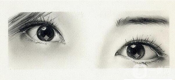 割雙眼皮,風(fēng)險