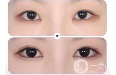 割雙眼皮,風(fēng)險