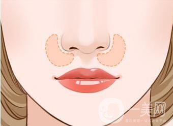 北京,鼻翼縮小,多少錢