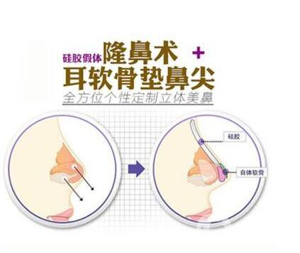 北京,耳軟骨墊鼻尖,價(jià)格