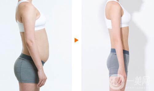 上海360度吸脂多少錢 360度吸脂價(jià)格詳解