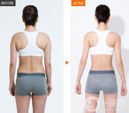 上海360度吸脂多少錢 360度吸脂價(jià)格詳解