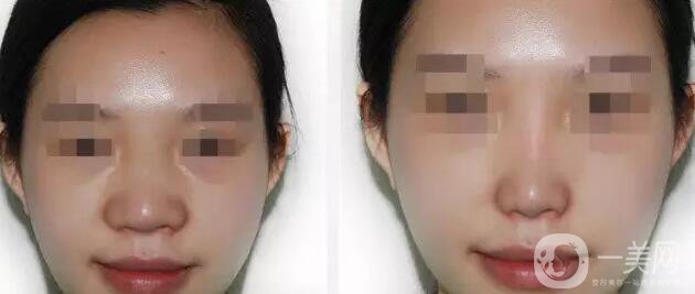 深圳鼻翼縮小多少錢能做 鼻翼縮小手術價格詳解