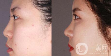 *術(shù)后1-7天的反應(yīng) *術(shù)后怎么護(hù)理