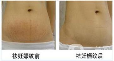 去除妊娠斑,去妊娠紋,方法