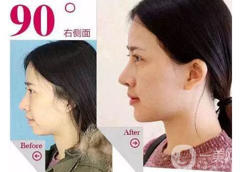 鼻子矯正,費(fèi)用