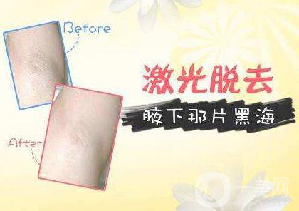 激光脫腋毛,價格