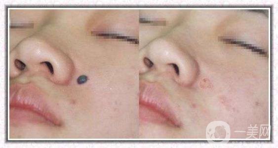 去痣多少錢 祛痣價位詳情一覽