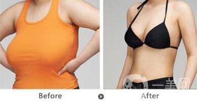 巨乳縮小術(shù)疤痕大嗎 巨乳縮小會留疤嗎