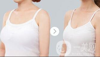 巨乳縮小術(shù)疤痕大嗎 巨乳縮小會留疤嗎