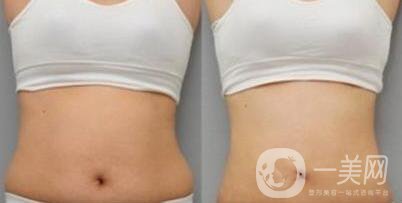 腰腹吸脂后多久變細 腰腹吸脂幾天恢復(fù)