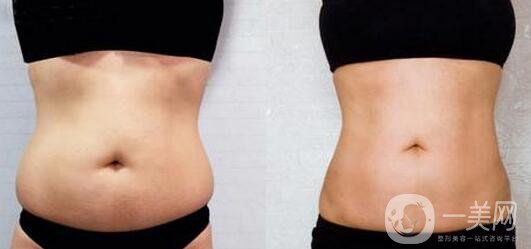 腰腹吸脂后多久變細 腰腹吸脂幾天恢復(fù)