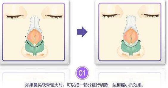 鼻頭縮小*果 鼻頭縮小術(shù)后*果