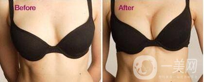 假體隆胸,注意事項
