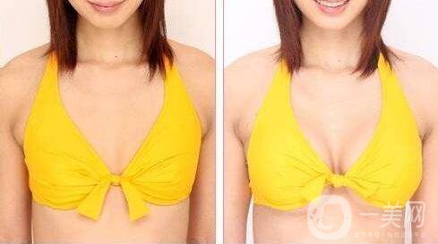 北京隆胸手術(shù)一般多少錢 價格是多少