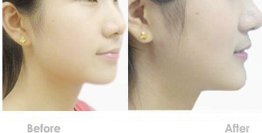 墊下巴,費(fèi)用