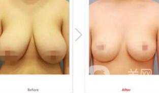 乳房縮小手術*嗎 乳房縮小有風險嗎