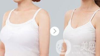 乳房縮小手術*嗎 乳房縮小有風險嗎