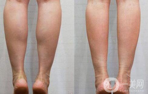 *瘦小腿多少錢 *瘦小腿價(jià)格詳情