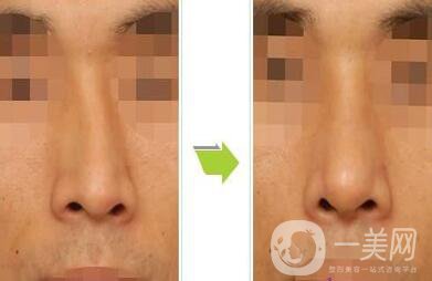 深圳歪鼻矯正一般多少錢(qián) 歪鼻矯正的價(jià)格詳解