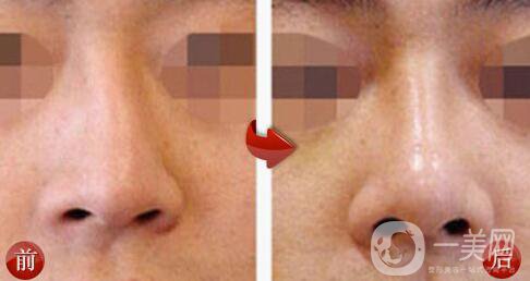 深圳歪鼻矯正一般多少錢(qián) 歪鼻矯正的價(jià)格詳解