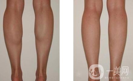 廣東注射瘦腿多少錢 注射瘦腿價(jià)格詳解