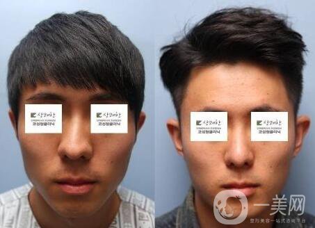 鼻歪矯正手術痛苦嗎？ 鼻歪矯正手術有多痛苦？