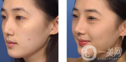 駝峰鼻矯正價錢 駝峰鼻矯正手術(shù)具體費用