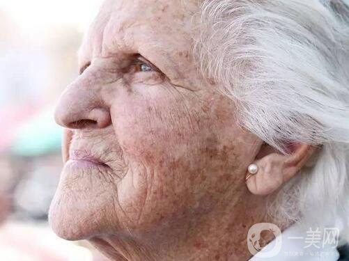 老年斑怎么調節(jié) 激光去老年斑怎么樣