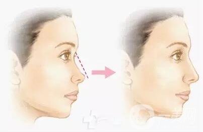 瑞蘭玻尿酸隆鼻價(jià)格 瑞蘭玻尿酸隆鼻多少錢