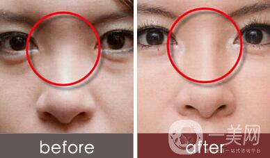 瑞蘭玻尿酸隆鼻價(jià)格 瑞蘭玻尿酸隆鼻多少錢