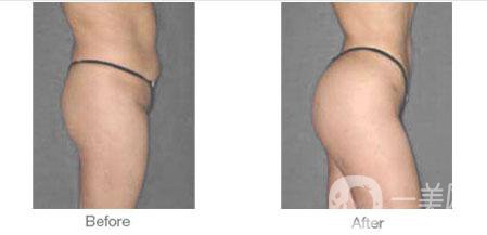 廣東豐臀手術多少錢 影響因素有哪些？