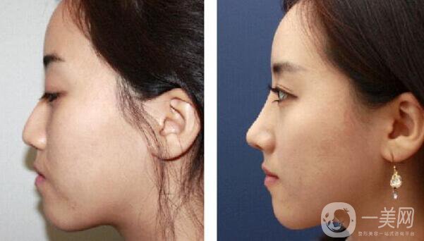 深圳,自體隆鼻,多少錢(qián)