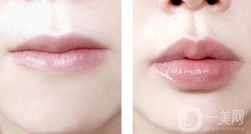 玻尿酸豐唇費(fèi)用 玻尿酸豐唇多少錢