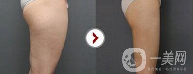 北京,自體脂肪豐臀,多少錢