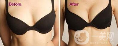 假體隆胸多久變得柔軟  多久徹底恢復